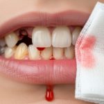 Is Bleeding Normal After a Tooth Extraction?